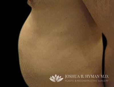 Liposuction Before & After Gallery - Patient 58232392 - Image 1