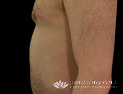 Liposuction Before & After Gallery - Patient 58232392 - Image 2