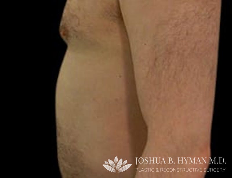 Liposuction Before & After Gallery - Patient 58232392 - Image 2