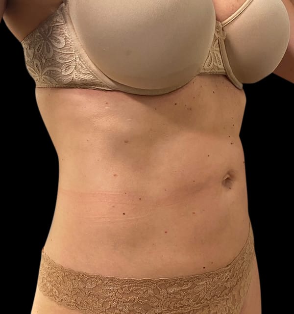 Liposuction Before & After Gallery - Patient 58232412 - Image 2