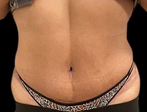 Abdominoplasty Before & After Gallery - Patient 58232328 - Image 2