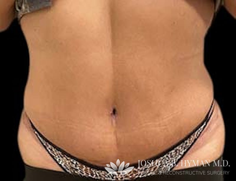 Abdominoplasty Before & After Gallery - Patient 58232328 - Image 2
