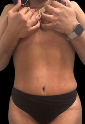 Abdominoplasty Before & After Gallery - Patient 58232332 - Image 2