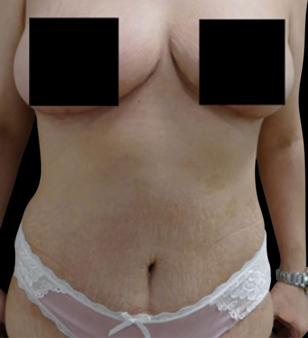 Abdominoplasty Before & After Gallery - Patient 58232341 - Image 2