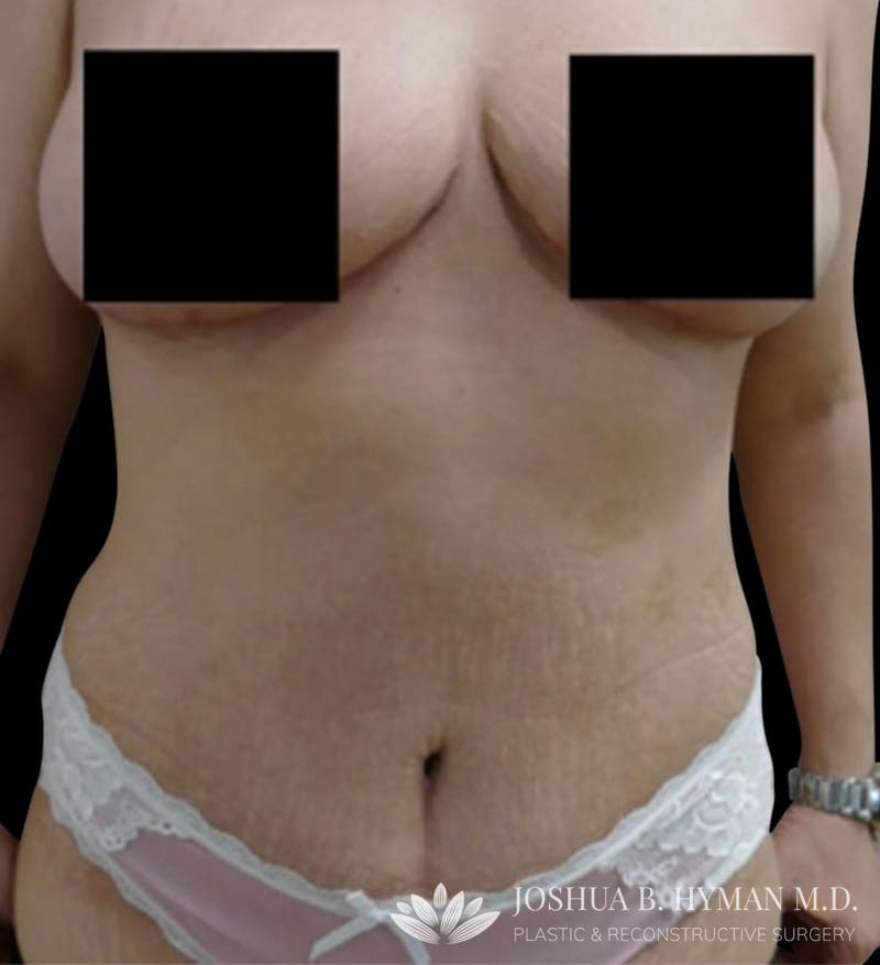 Abdominoplasty Before & After Gallery - Patient 58232341 - Image 2
