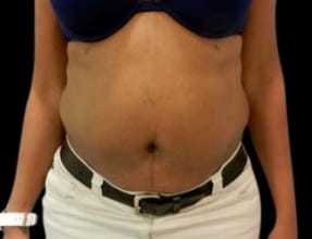 Abdominoplasty Before & After Gallery - Patient 58232354 - Image 1