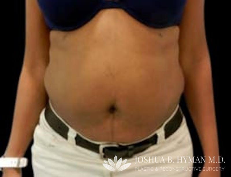 Abdominoplasty Before & After Gallery - Patient 58232354 - Image 1