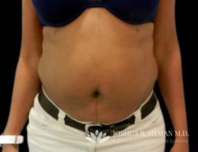 Abdominoplasty Before & After Gallery - Patient 58232354 - Image 1