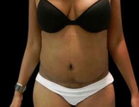 Abdominoplasty Before & After Gallery - Patient 58232354 - Image 2
