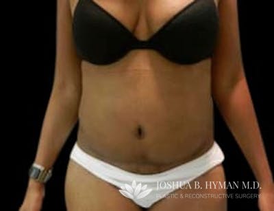 Abdominoplasty Before & After Gallery - Patient 58232354 - Image 2