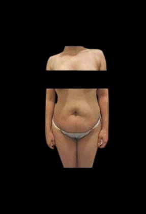 Abdominoplasty Before & After Gallery - Patient 58232363 - Image 1