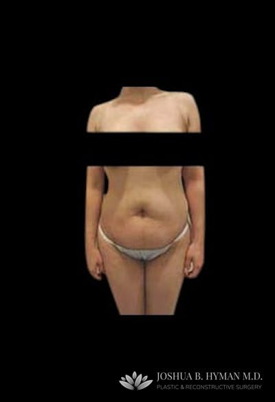 Abdominoplasty Before & After Gallery - Patient 58232363 - Image 1