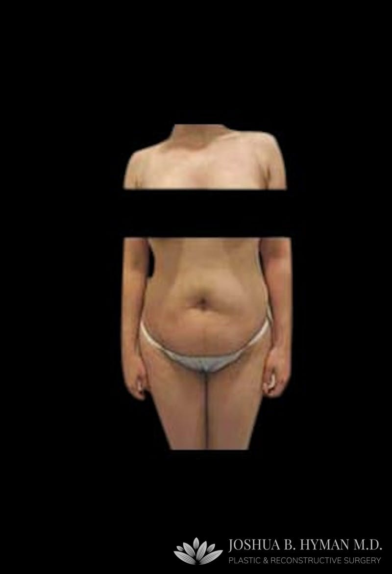 Abdominoplasty Before & After Gallery - Patient 58232363 - Image 1