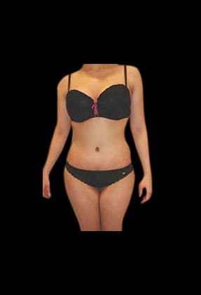Abdominoplasty Before & After Gallery - Patient 58232363 - Image 2