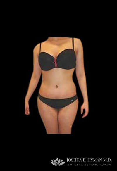 Abdominoplasty Before & After Gallery - Patient 58232363 - Image 2