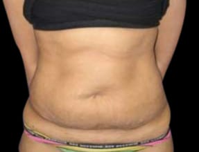 Abdominoplasty Before & After Gallery - Patient 58232367 - Image 1