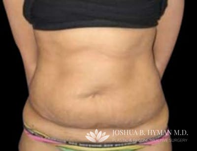Abdominoplasty Before & After Gallery - Patient 58232367 - Image 1