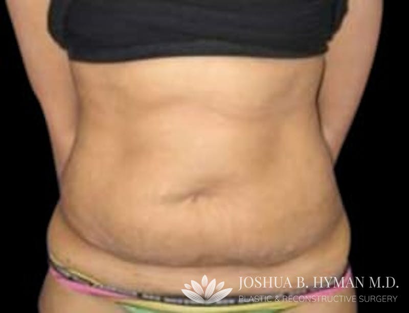 Abdominoplasty Before & After Gallery - Patient 58232367 - Image 1