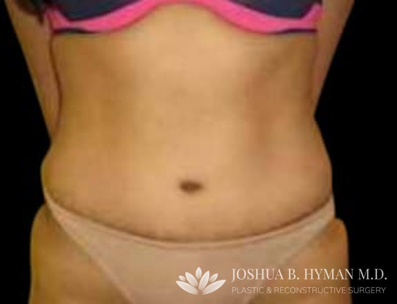 Abdominoplasty Before & After Gallery - Patient 58232367 - Image 2