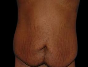 Abdominoplasty Before & After Gallery - Patient 58232376 - Image 1