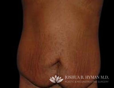 Abdominoplasty Before & After Gallery - Patient 58232376 - Image 1