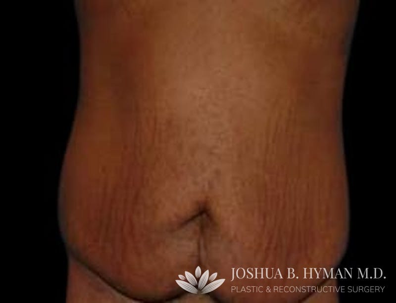 Abdominoplasty Before & After Gallery - Patient 58232376 - Image 1