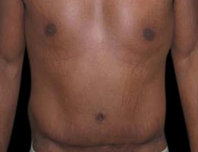 Abdominoplasty Before & After Gallery - Patient 58232376 - Image 2