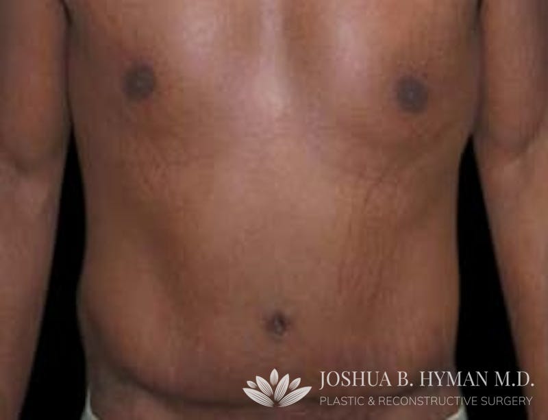 Abdominoplasty Before & After Gallery - Patient 58232376 - Image 2