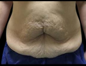 Abdominoplasty Before & After Gallery - Patient 58232380 - Image 1
