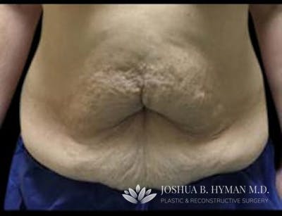 Abdominoplasty Before & After Gallery - Patient 58232380 - Image 1
