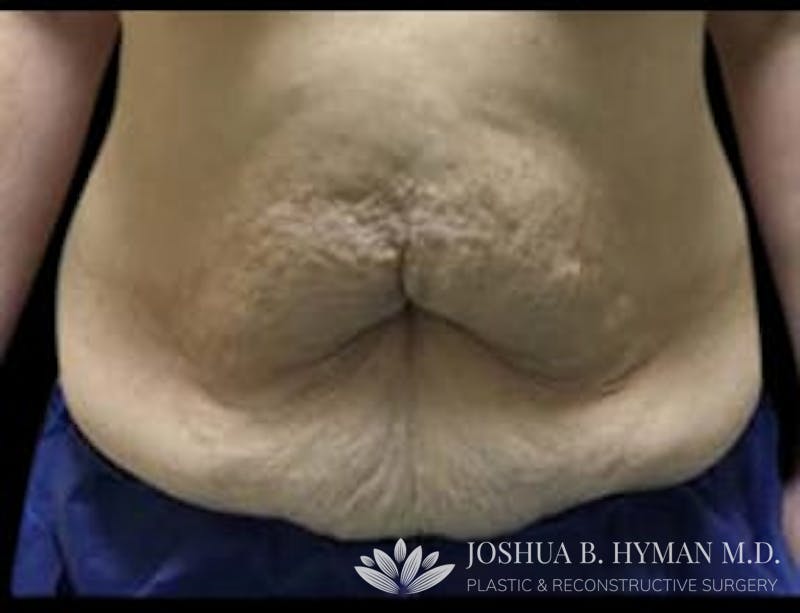 Abdominoplasty Before & After Gallery - Patient 58232380 - Image 1