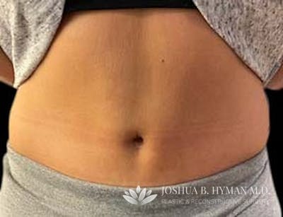 Abdominoplasty Before & After Gallery - Patient 58232385 - Image 2