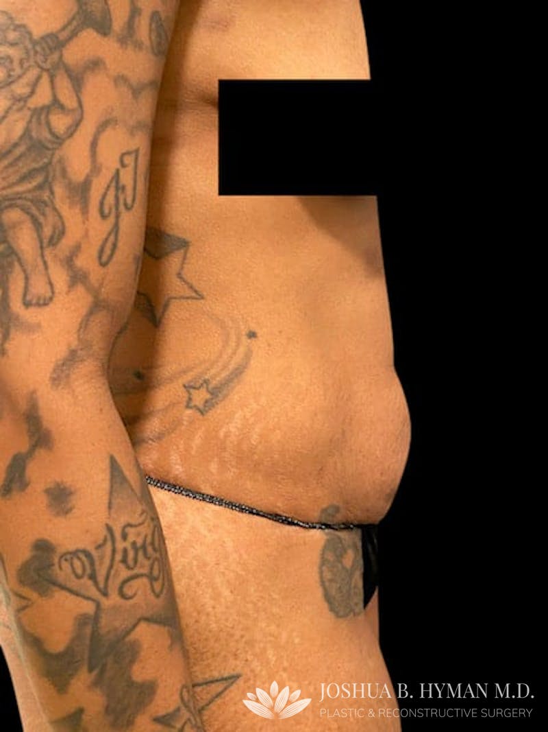 Abdominoplasty Before & After Gallery - Patient 58232400 - Image 3