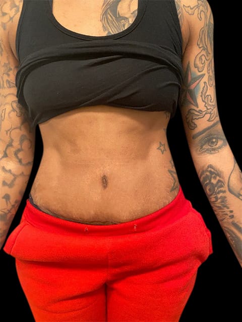 Abdominoplasty Before & After Gallery - Patient 58232400 - Image 2