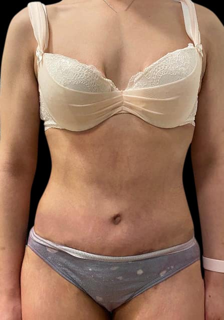 Abdominoplasty Before & After Gallery - Patient 58232405 - Image 2