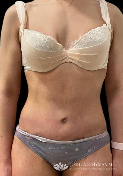 Abdominoplasty Before & After Gallery - Patient 58232405 - Image 2