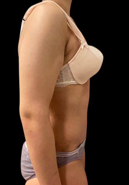 Abdominoplasty Before & After Gallery - Patient 58232405 - Image 4