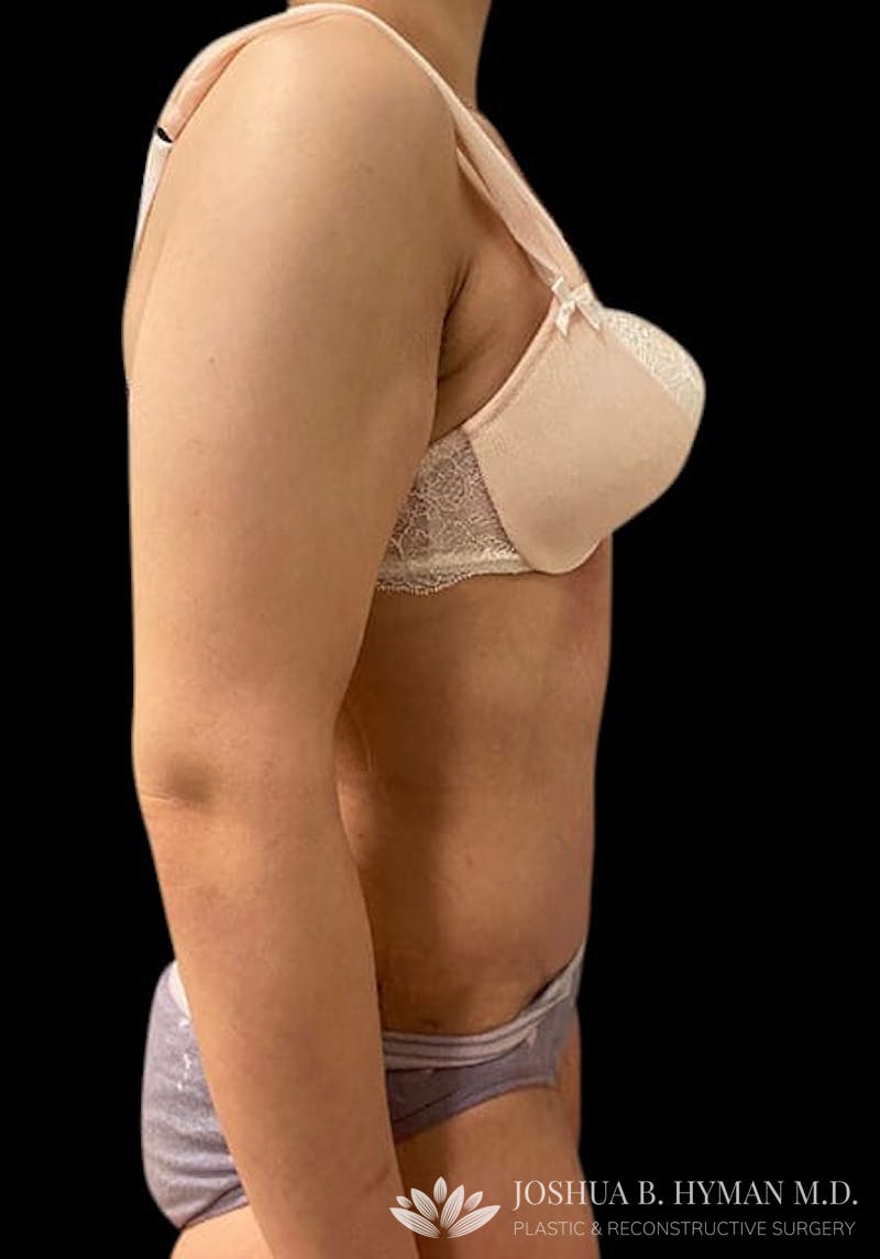 Abdominoplasty Before & After Gallery - Patient 58232405 - Image 4