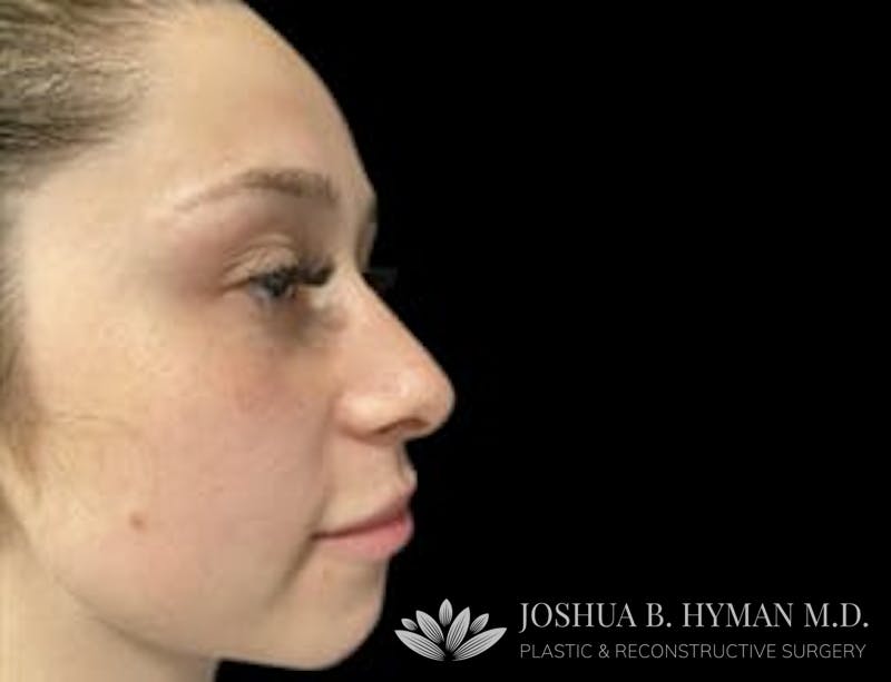 Rhinoplasty Before & After Gallery - Patient 58232309 - Image 1