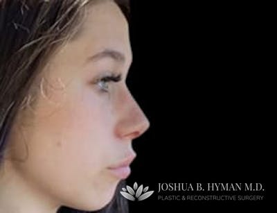 Rhinoplasty Before & After Gallery - Patient 58232309 - Image 2