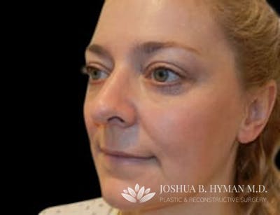 Rhinoplasty Before & After Gallery - Patient 58232333 - Image 2