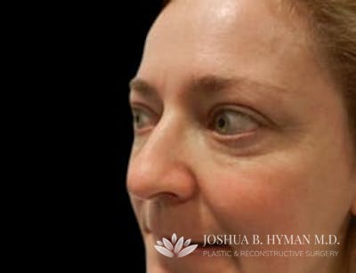 Rhinoplasty Before & After Gallery - Patient 58232333 - Image 1