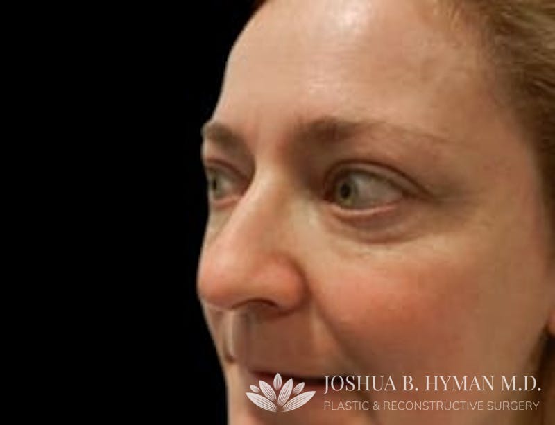 Rhinoplasty Before & After Gallery - Patient 58232333 - Image 1