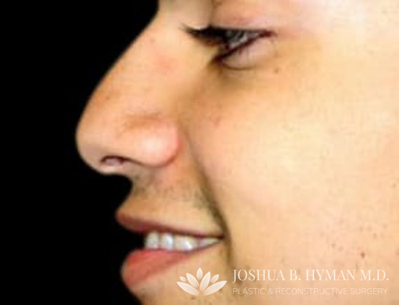 Rhinoplasty Before & After Gallery - Patient 58232335 - Image 1