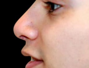 Rhinoplasty Before & After Gallery - Patient 58232335 - Image 2