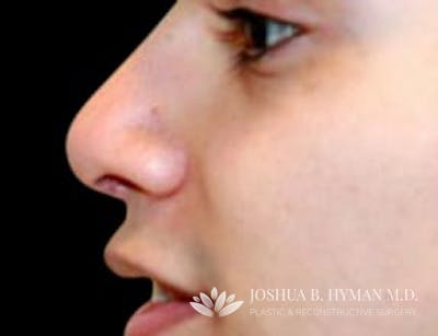 Rhinoplasty Before & After Gallery - Patient 58232335 - Image 2