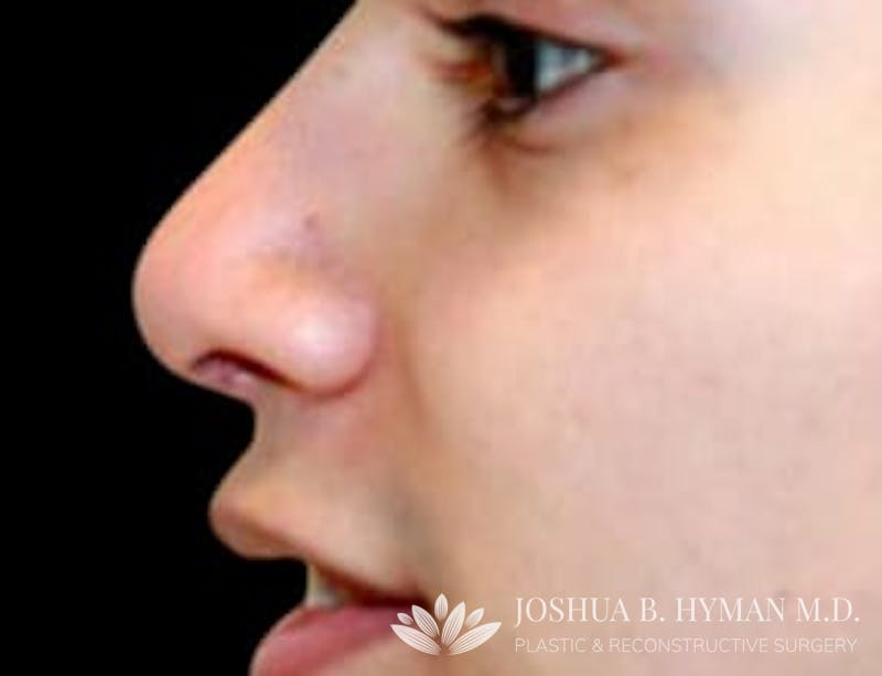 Rhinoplasty Before & After Gallery - Patient 58232335 - Image 2