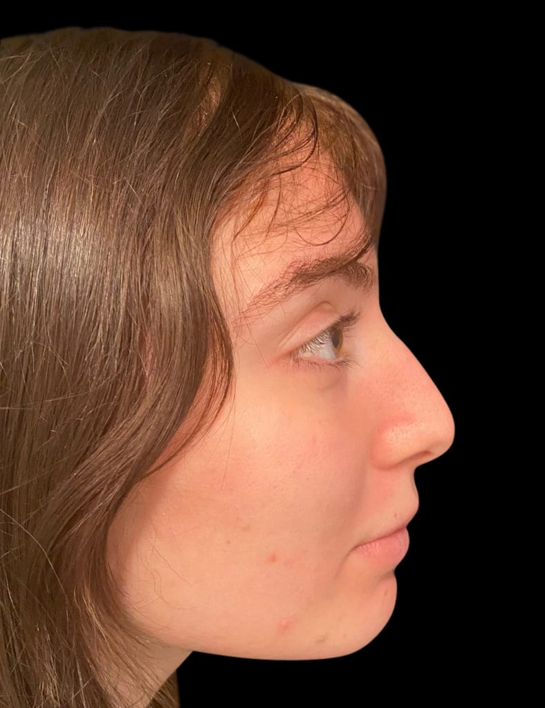 Rhinoplasty Before & After Gallery - Patient 58232347 - Image 1