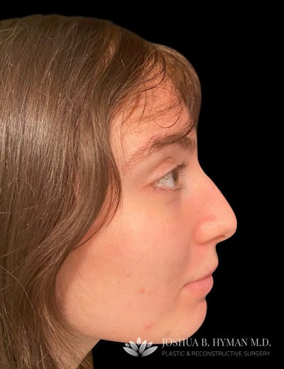Rhinoplasty Before & After Gallery - Patient 58232347 - Image 1