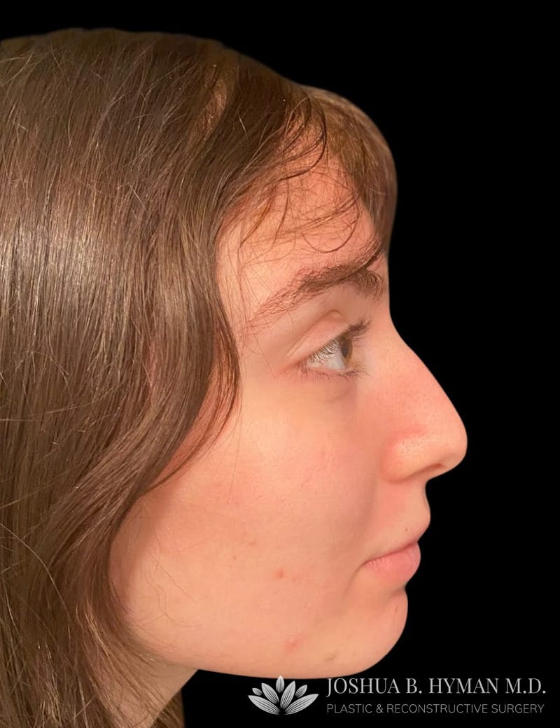 Rhinoplasty Before & After Gallery - Patient 58232347 - Image 1